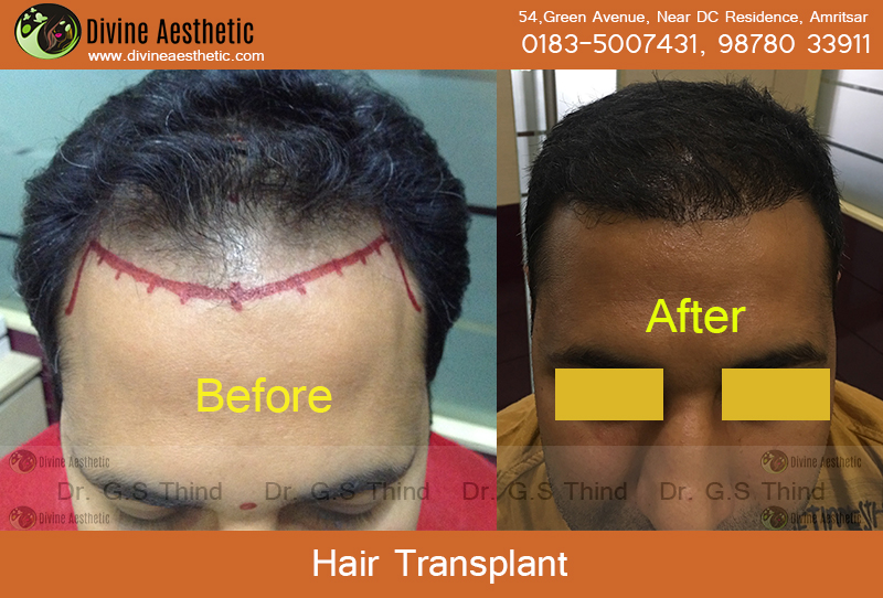 hair transplant clinic in amritsar|cosmetic surgeons in amritsar