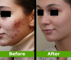 Acne Scar Before And After Treatment