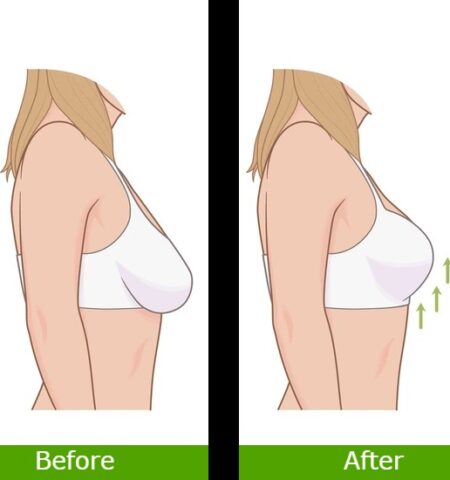 Breast Tightening Before And After Divine Result