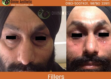 Dermafillers-1