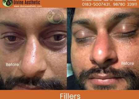 Dermafillers-2