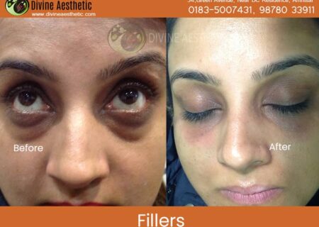 Dermafillers-3