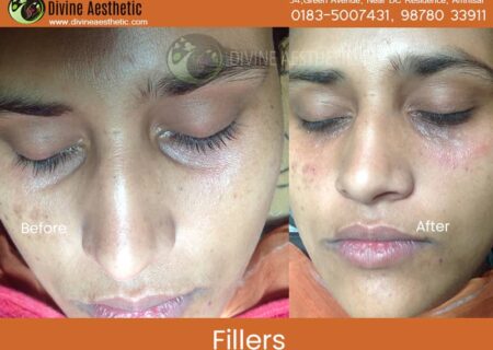 Dermafillers-5