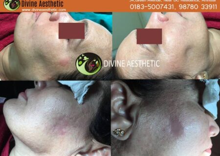 Dermafillers-6