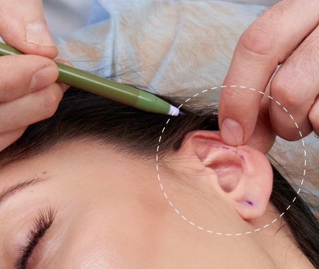 Ear Correction