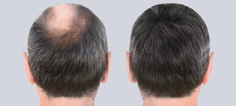 What Is FUE Hair Transplant