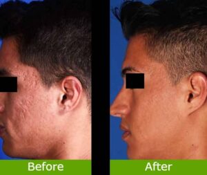 Laser Acne Pits Before And After