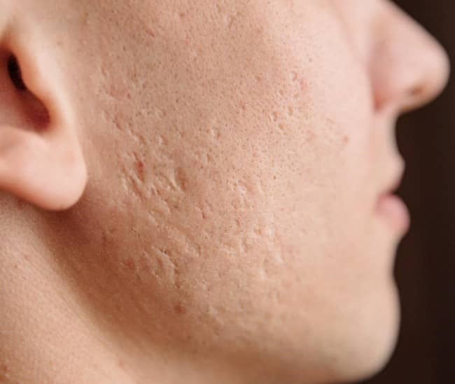 Laser Acne Pits