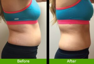 Laser Liposuction Before And After Divine Results