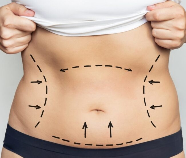 What Is Laser Liposuction