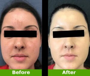 Laser Photo Facials Before And After Treatment