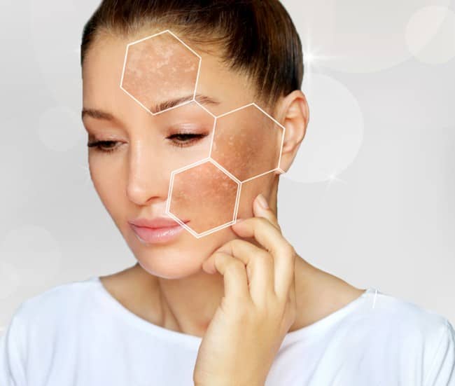 Laser Skin Pigmentation Treatment