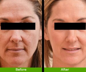 Laser Skin Tightening Before And After Divine Result