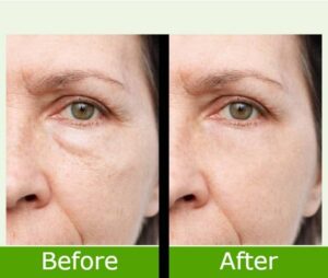 Laser Wrinkles Treatment Before And After