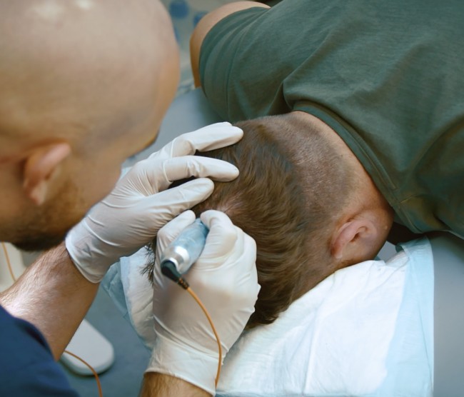 Scalp Micropigmentation