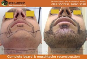 beard and moustache transplant