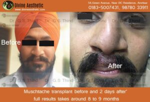 beard hair transplant in amritsar