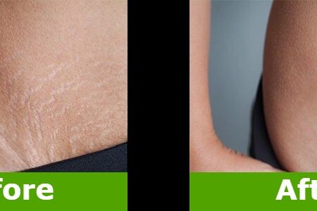 before-after-stretch-marks-removal