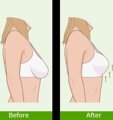 breast tightening before and after