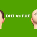 dhi vs fue hair transplant