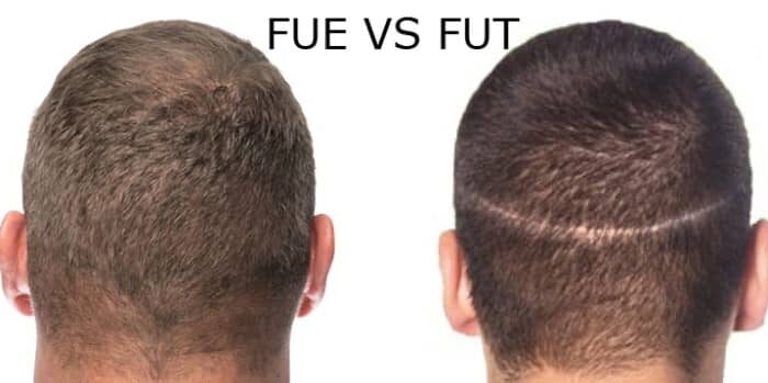 fue vs fut hair transplant