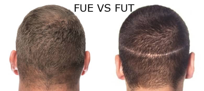 fue vs fut hair transplant